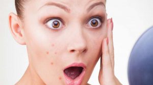 Aceite de neem contra el acne